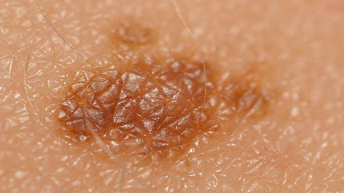 Pokožka často vystavená paprskům UV-A má vyšší tendenci bujení melanomu a fólie Infrasol zadrží 99 % tohoto záření
